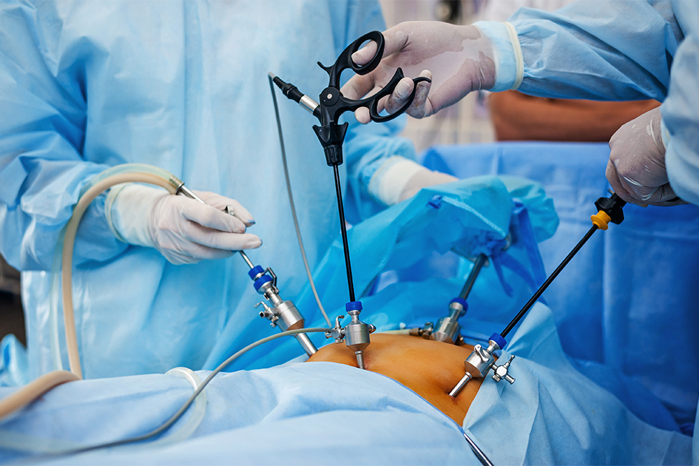 Во время лапароскопической операции врачи работают через маленькие проколы. Никаких больших разрезов для доступа в брюшную полость не делают, поэтому риск спаечной болезни после такой операции меньше. Источник: flywish / Shutterstock
