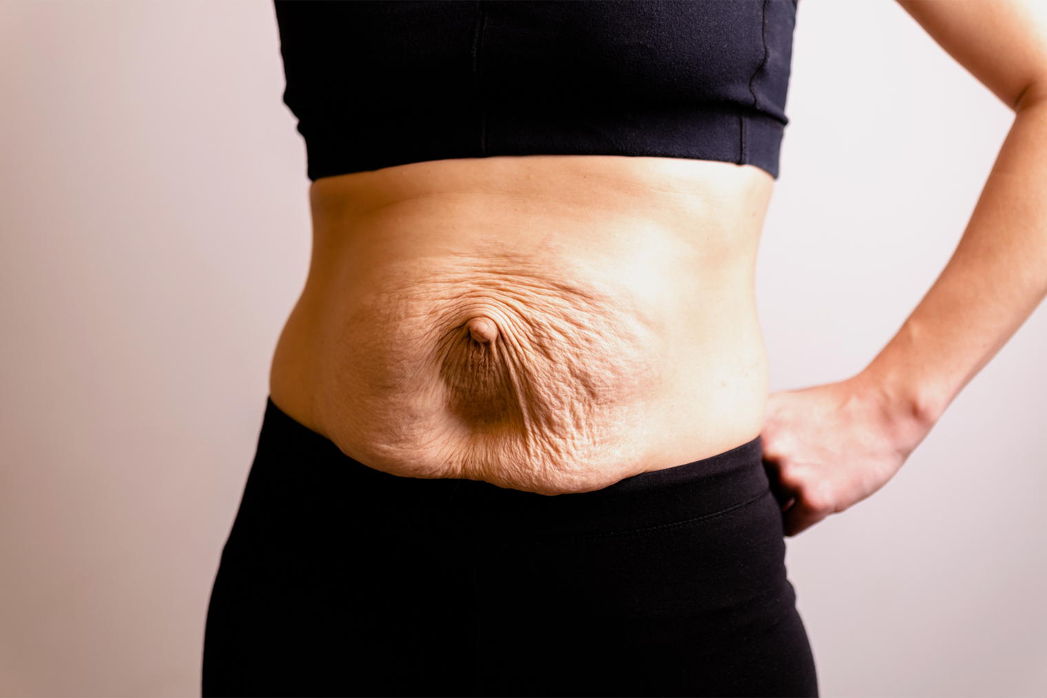 Если после родов вес уходит быстро, уже через несколько недель диастаз может стать заметным. Фотография — Habrovich / iStock