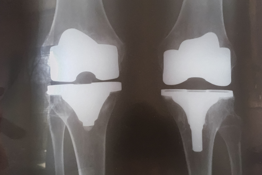 Рентгеновский снимок коленных суставов после протезирования. Надколенники тоже заменили, но на снимке их не видно