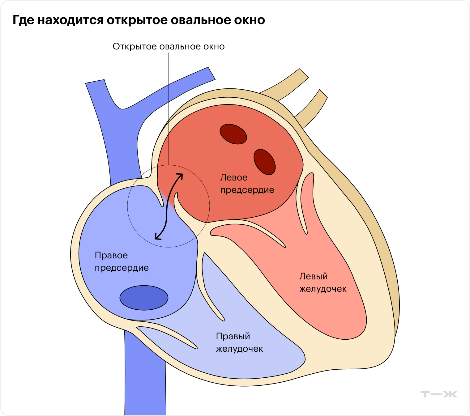 Нарушение речи при инсульте — Evexia