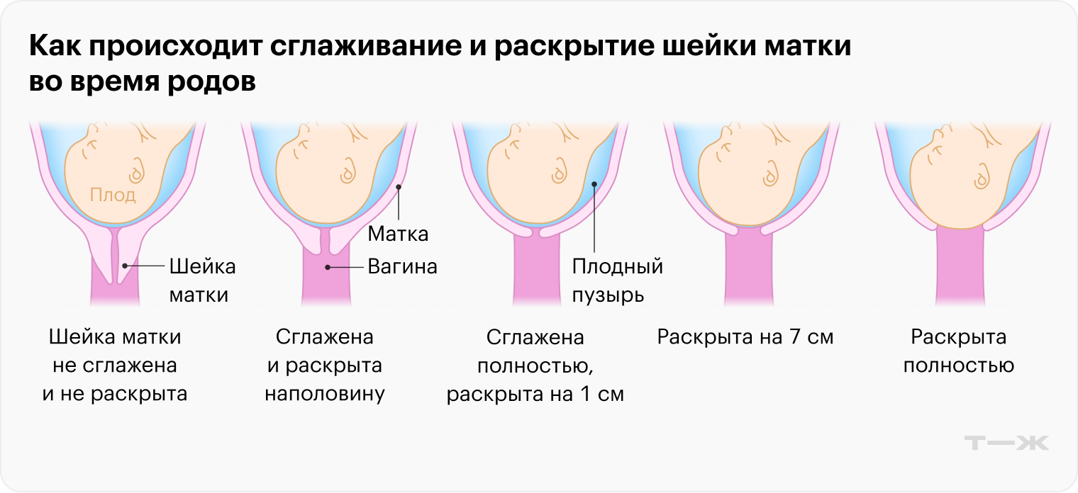 Как происходит сглаживание и раскрытие шейки матки во время родов