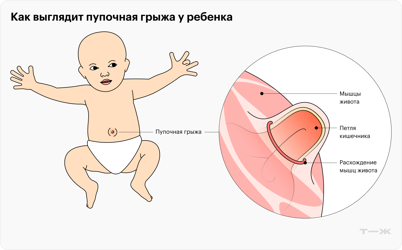 Так выглядит пупочная грыжа