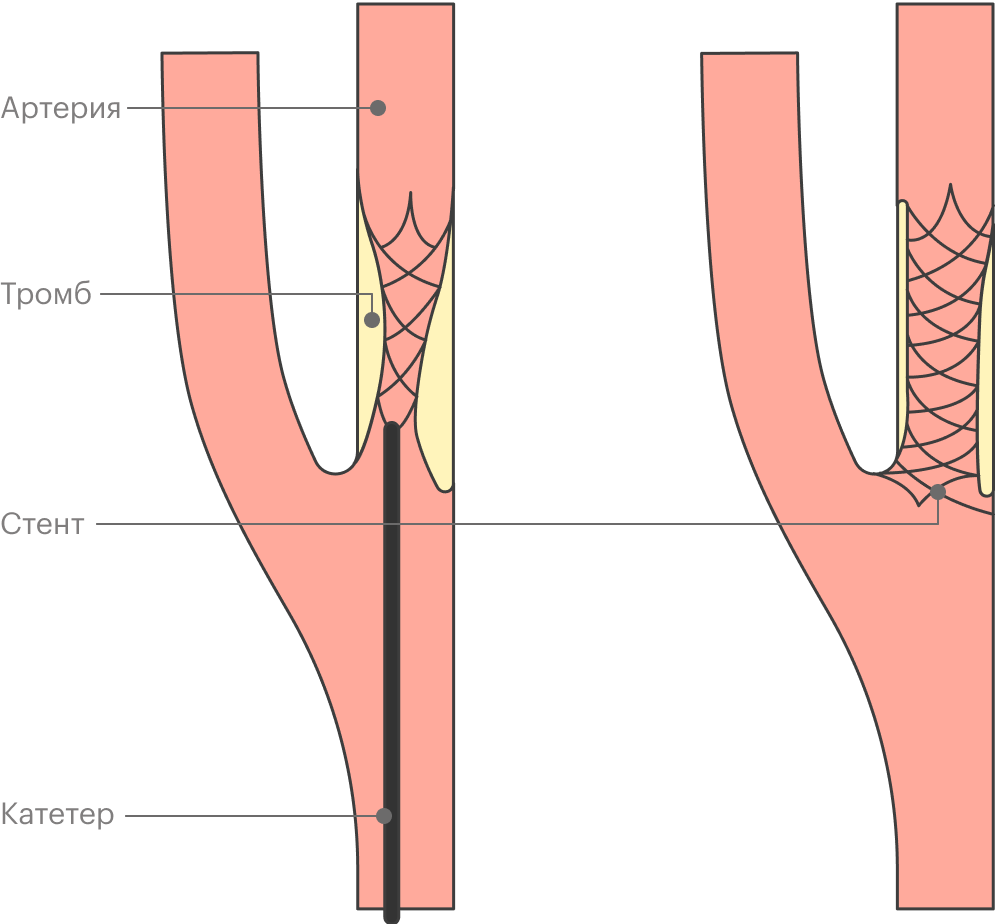 При стентировании с помощью катетера к месту сужения артерии подводят стент, который восстанавливает и поддерживает просвет сосуда