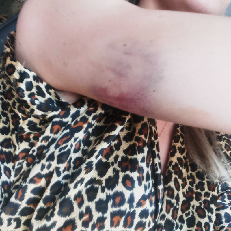 Вот такие синяки у меня остались