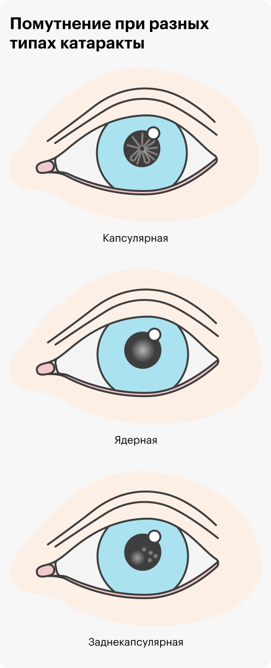Помутнение при разных типах катаракты будет выглядеть по-разному: при капсулярной оно напоминает расходящиеся лучи, при ядерной располагается в центре зрачка, при заднекапсулярной смещено от центра зрачка