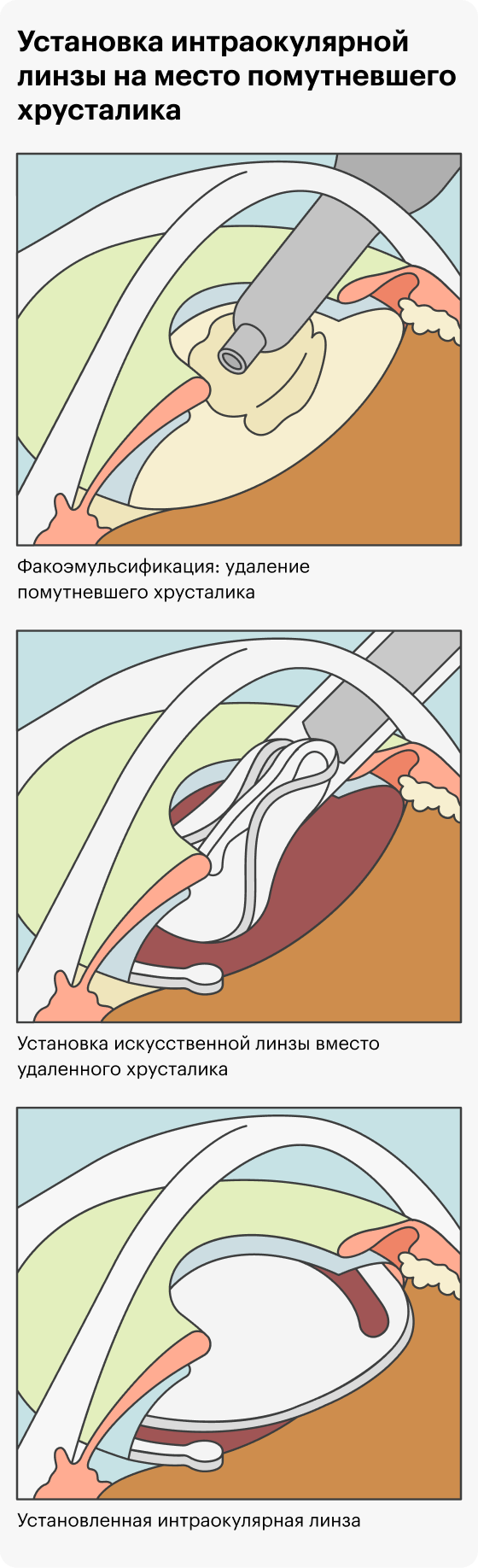 Установка интраокулярной линзы на место помутневшего хрусталика. Источник: iris-center.ru
