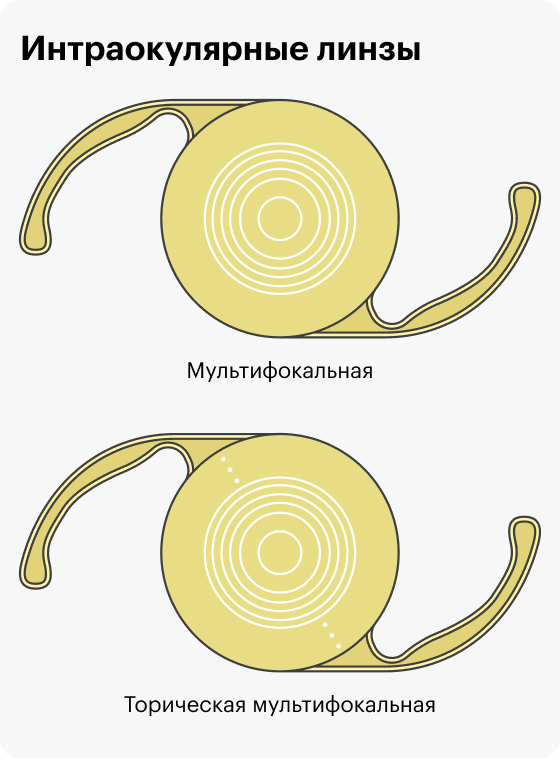 Так выглядят мои интраокулярные линзы — мультифокальная и торическая мультифокальная. Желтый фильтр защищает сетчатку от ультрафиолетовых лучей, а усики помогают зафиксировать линзу в правильном положении. Диаметр линзы — 6 мм, с усиками — 13 мм