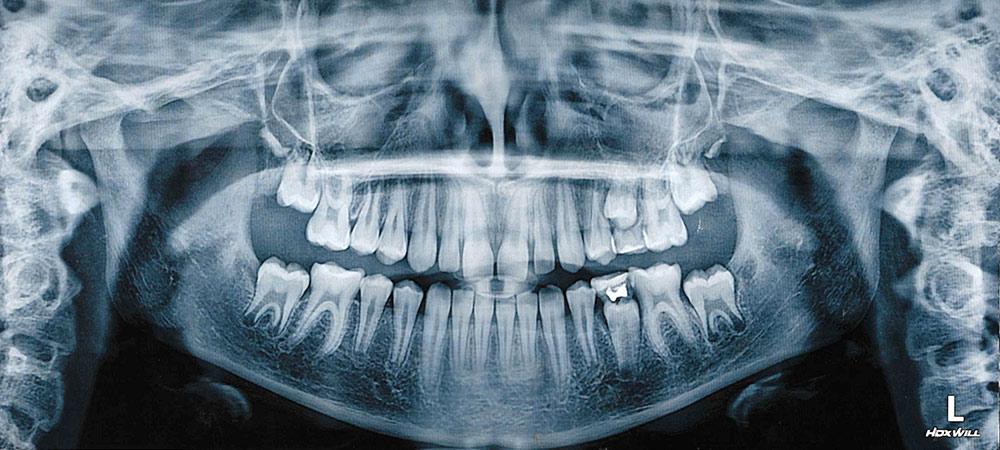 Снимок, на котором видна пломба на «пятерке» и два молочных зуба, которым было пора на выход