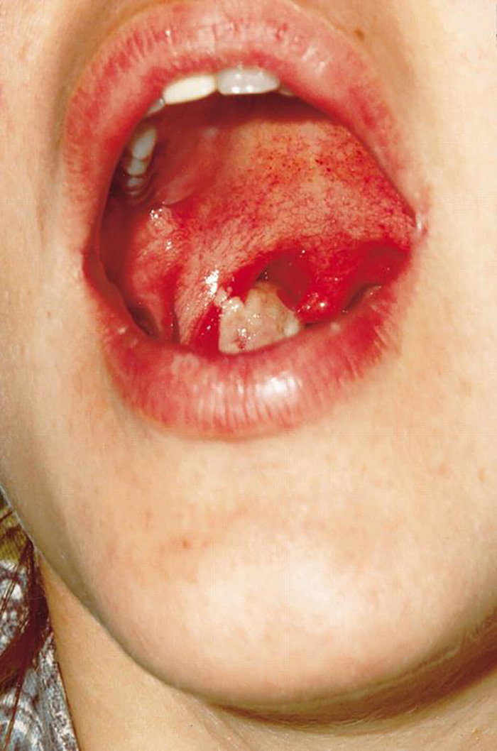 Дифтерийная мембрана — белый комок в правой части глотки. Источник: academic.oup.com