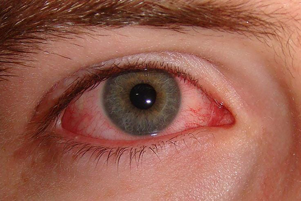 При вирусном конъюнктивите, как на иллюстрации, обычно розовеют белки обоих глаз. А при бактериальном из уголка глаза еще и выделятся бы гной. Источник: medscape.com