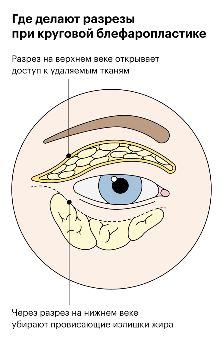 Круговая блефаропластика: отзыв об операции, фото век до и после, цена