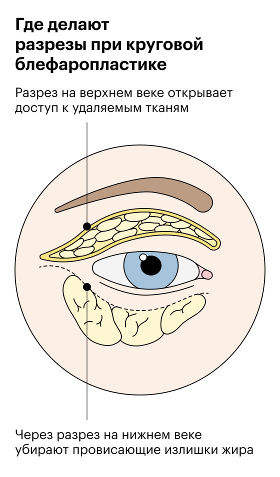 Блефарохалазис это