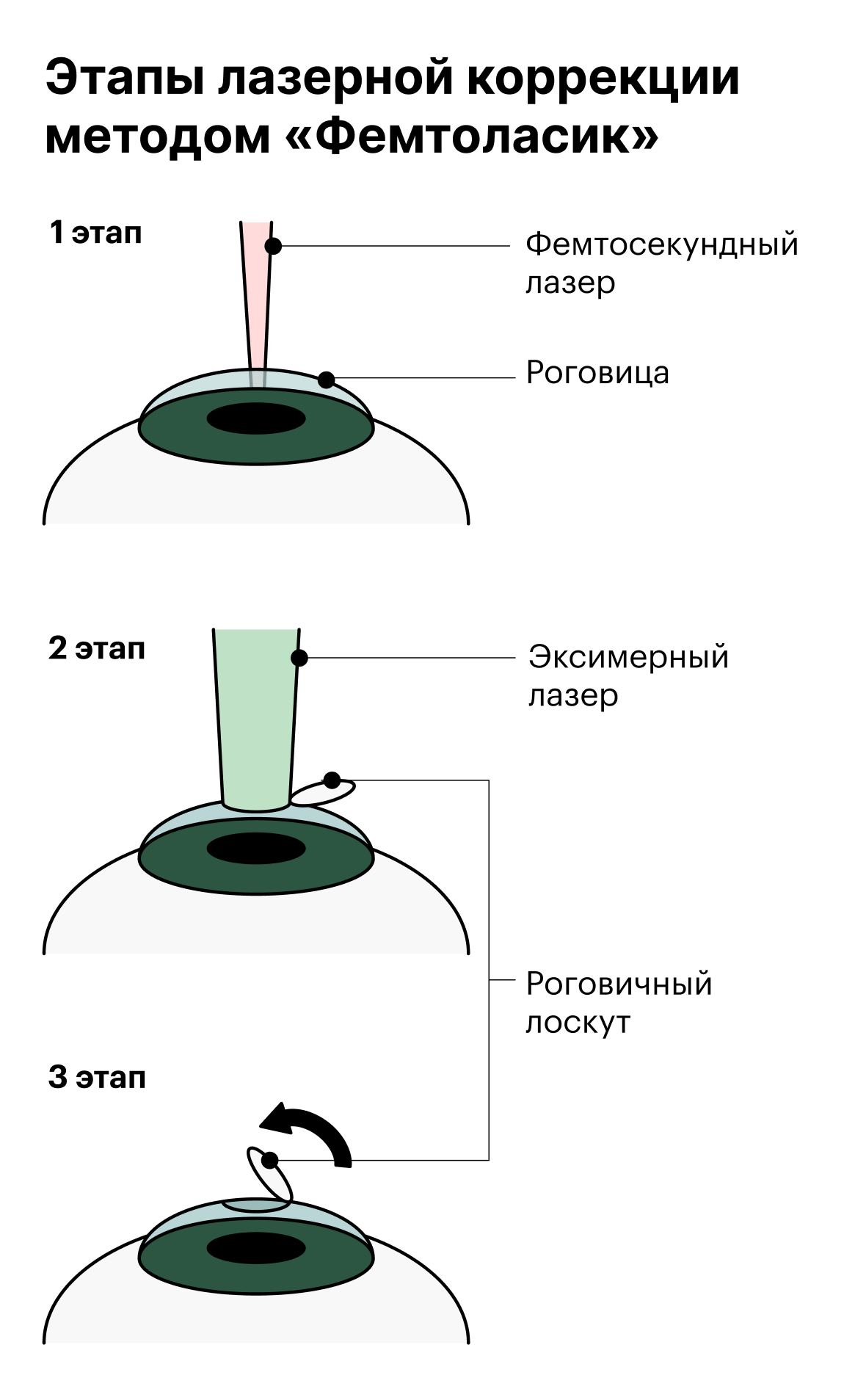 Первый этап — формирование роговичного лоскута фемтосекундным лазером.Второй этап — изменение формы роговицы с помощью эксимерного лазера.Третий этап — возвращение роговичного лоскута на местоИсточник: eyerounds.org