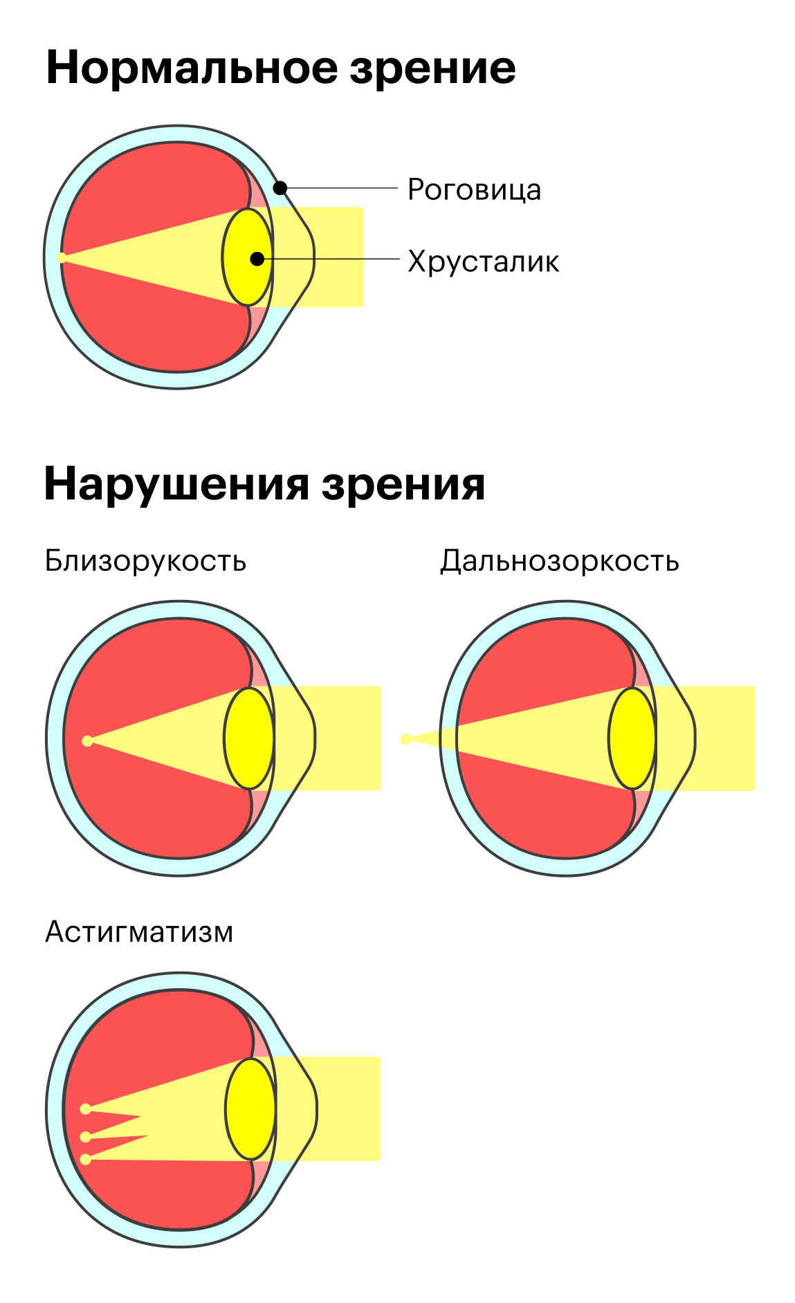 В норме лучи света преломляются через роговицу и хрусталик глаза и сходятся на сетчатке в одной точке. При нарушениях зрения лучи фокусируются перед сетчаткой, за ней или расходятся на несколько пучков. В ходе лазерной коррекции хирург меняет форму роговицы так, чтобы перенаправить лучи в нужное место