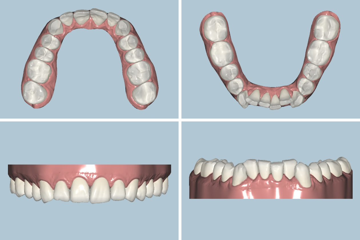 Это 3D⁠-⁠модель моих зубов до установки элайнеров — на сайте производителя ее можно рассмотреть в деталях. Верхние зубы в целом ровные, но они меняли свое положение, подстраиваясь под нижний ряд и новый прикус