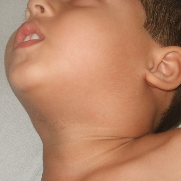 Почему у ребенка возникает увеличение лимфоузлов на шее: причины и лечение