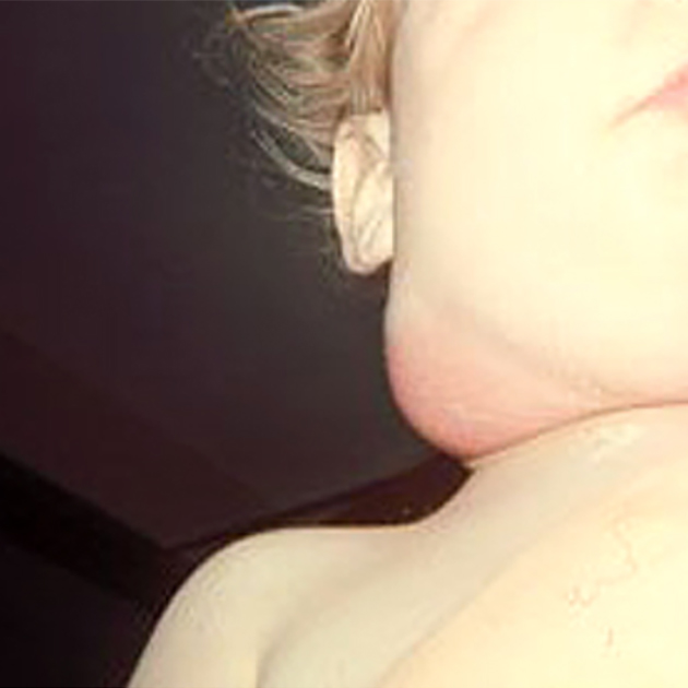 Шейный лимфаденит: кожа над воспаленным лимфоузлом покраснела. Источник: uptodate.com
