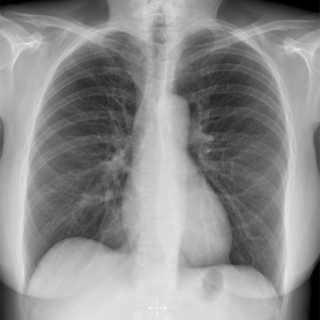 Нормальная рентгенограмма грудной клетки. Источник: radiopaedia.org