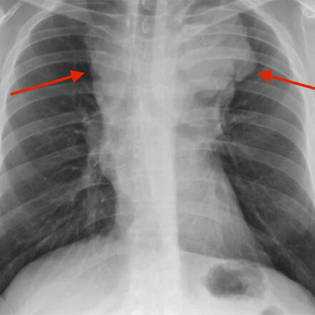 Рентгенограмма грудной клетки у пациента с лимфомой Ходжкина. Красные стрелки указывают на расширение средостения из⁠-⁠за увеличенных лимфоузлов. Источник: link.springer.com