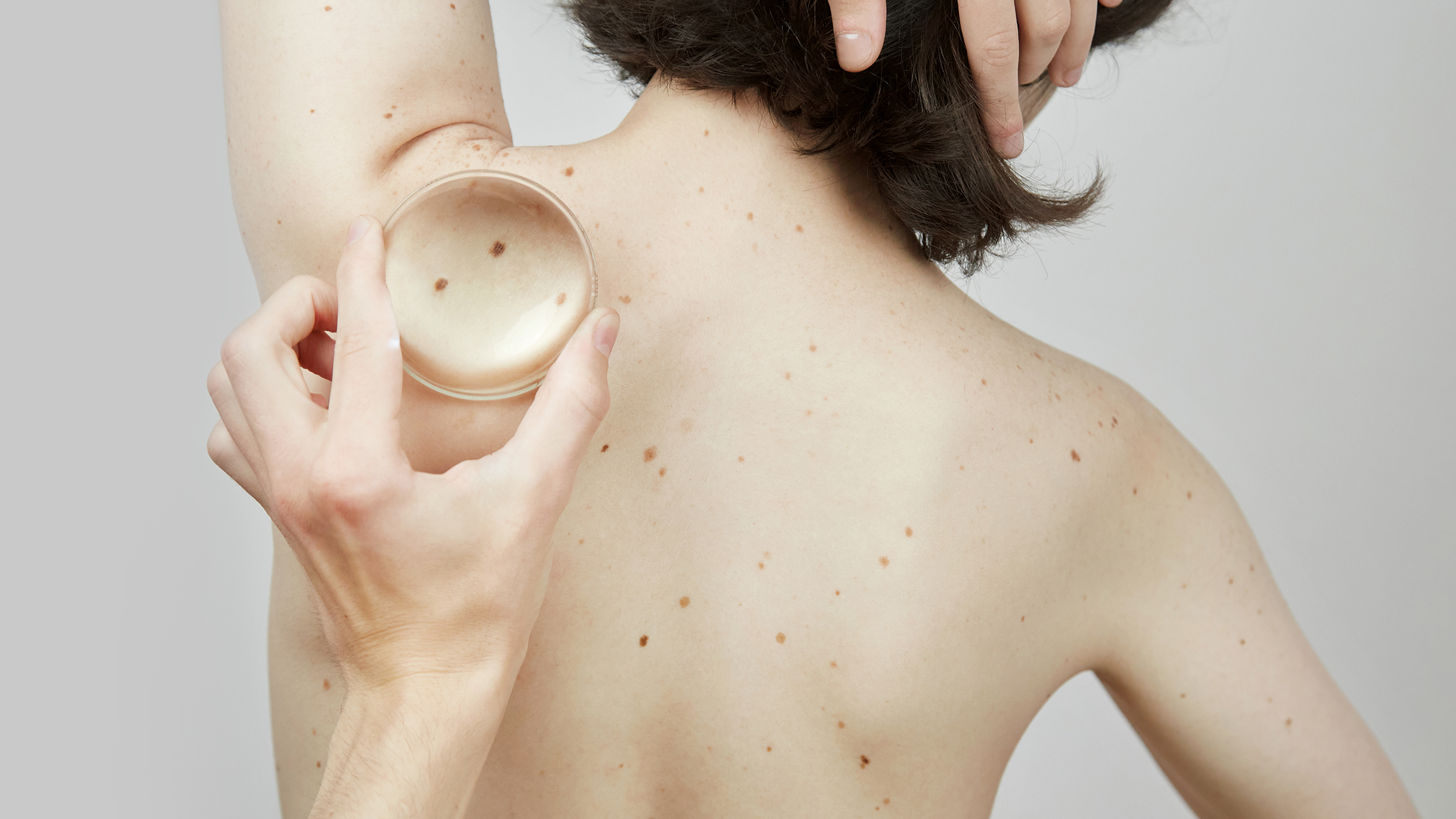 Как распознать рак кожи и где его лечить: советы онколога