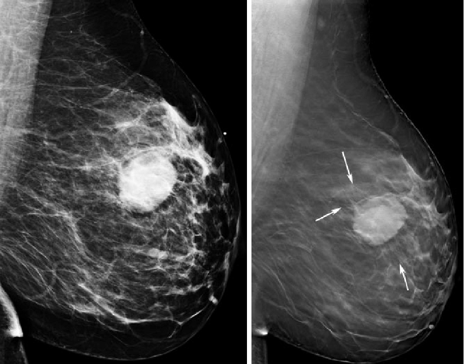 Так может выглядеть раковая опухоль груди на маммографии. Источник: researchgate.net