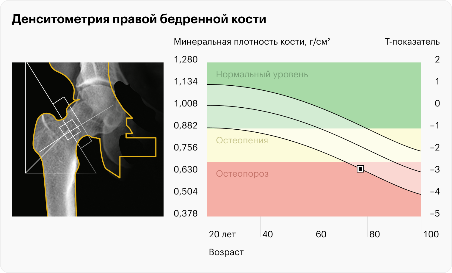 Так выглядит результат денситометрии: показатели в зеленой зоне говорят о нормальной плотности костей, в желтой — о ее снижении, в красной — об остеопорозе. В Москве денситометрия одной зоны стоит от 2000 ₽