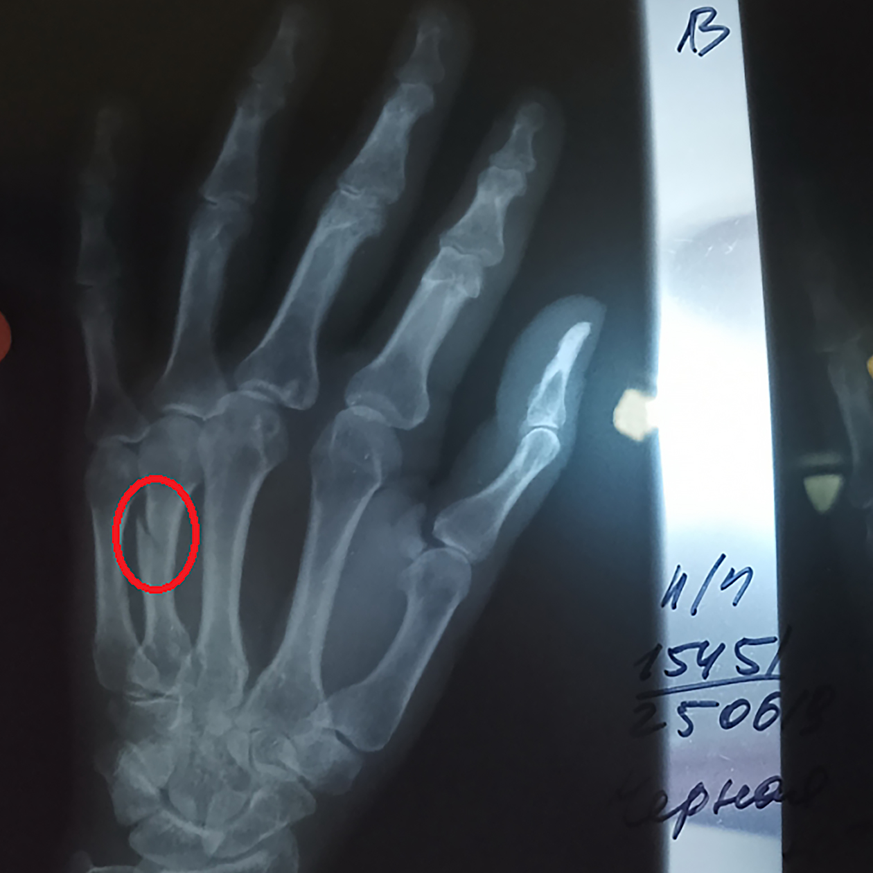 Это рентгеновский снимок, красным кружком выделено место перелома