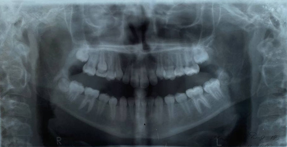Это мои зубы в 12 лет. По снимку можно заметить, что нижняя челюсть гораздо крупнее верхней