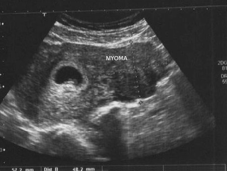 УЗИ-снимок миомы при беременности в восемь недель. Темное пятно слева от подписи «миома» — плодное яйцо. Источник