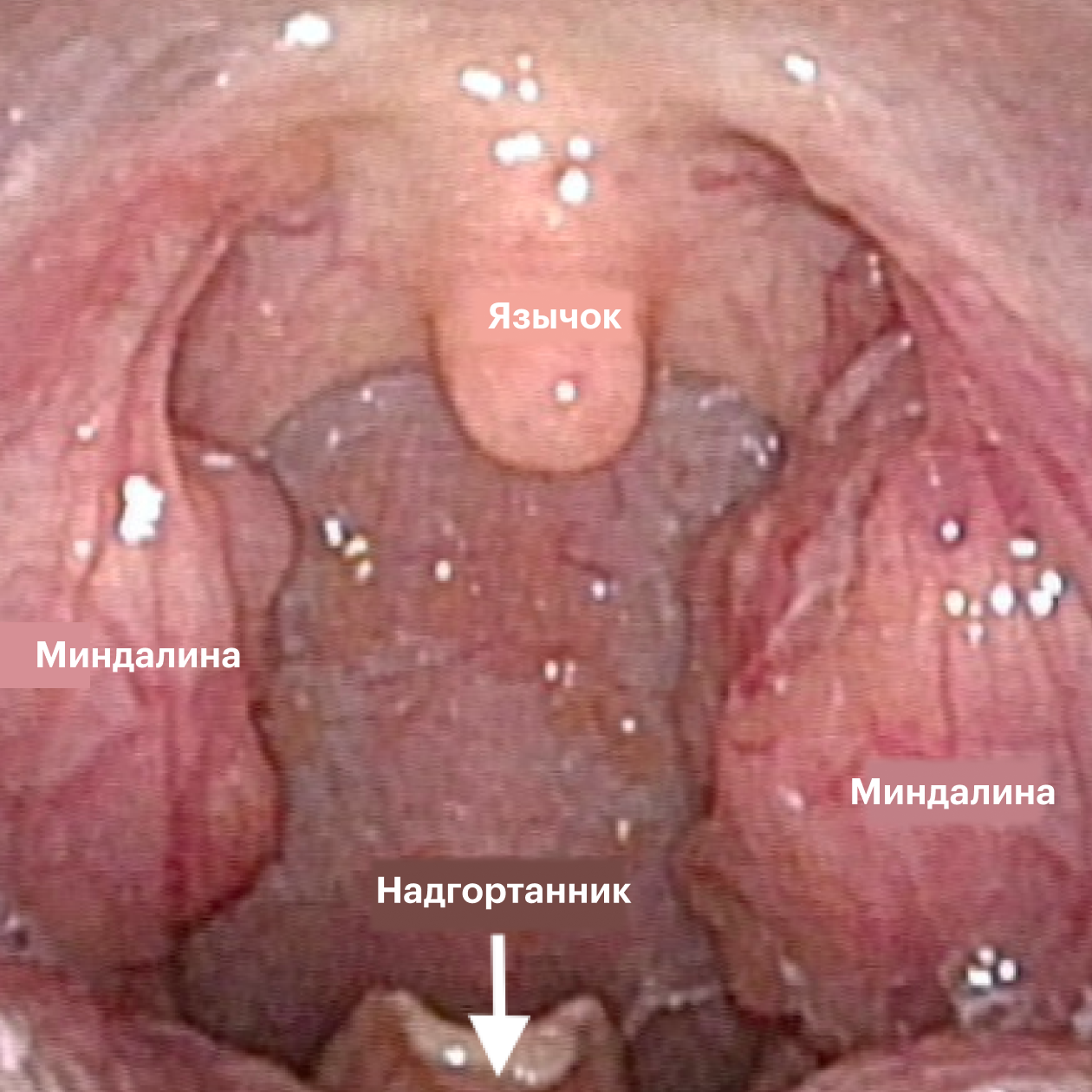 Воспаленное горло (sore throat) - фарингит, тонзиллит, ангина