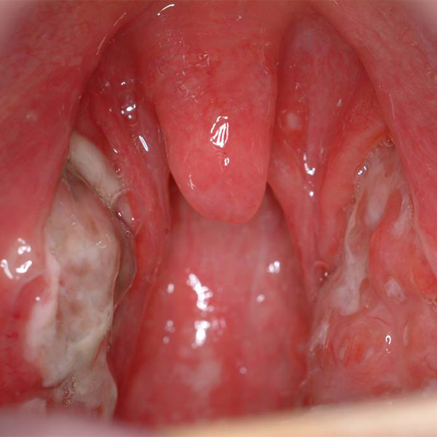 А это типичная картина во рту при мононуклеозе: воспаленные миндалины с налетом, красное горло. Источник: entspecialist.sg