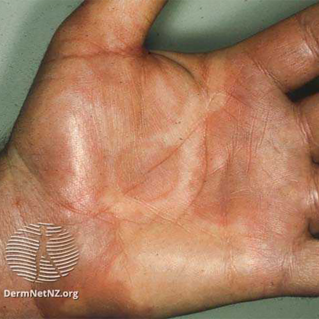 Крапивница при мононуклеозе: появление возвышающихся над кожей отечных образований. Источник: dermnetnz.org