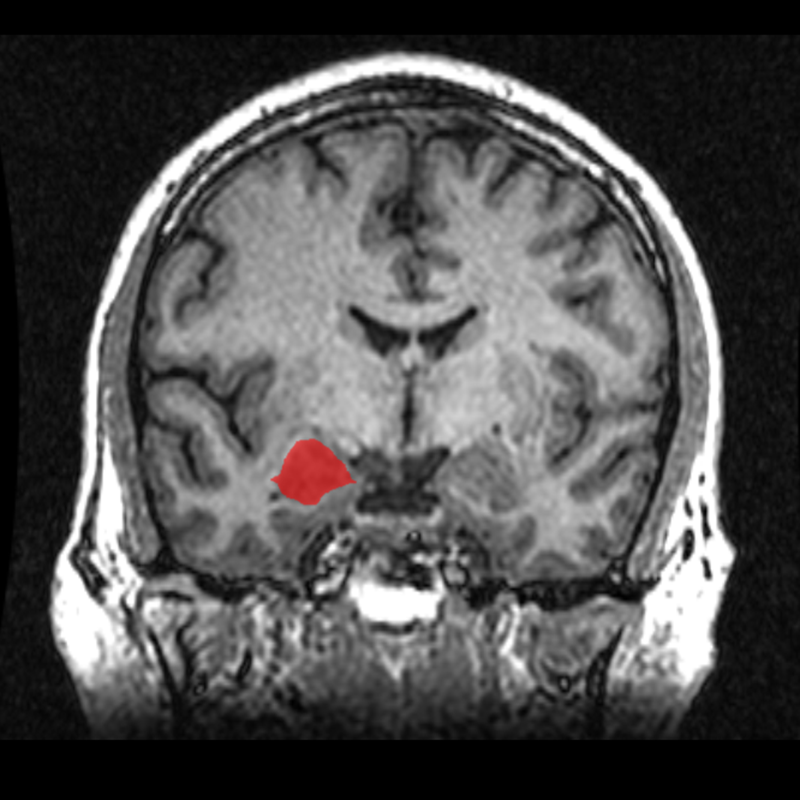 МРТ-изображение амигдалы. Источник: «Википедия»