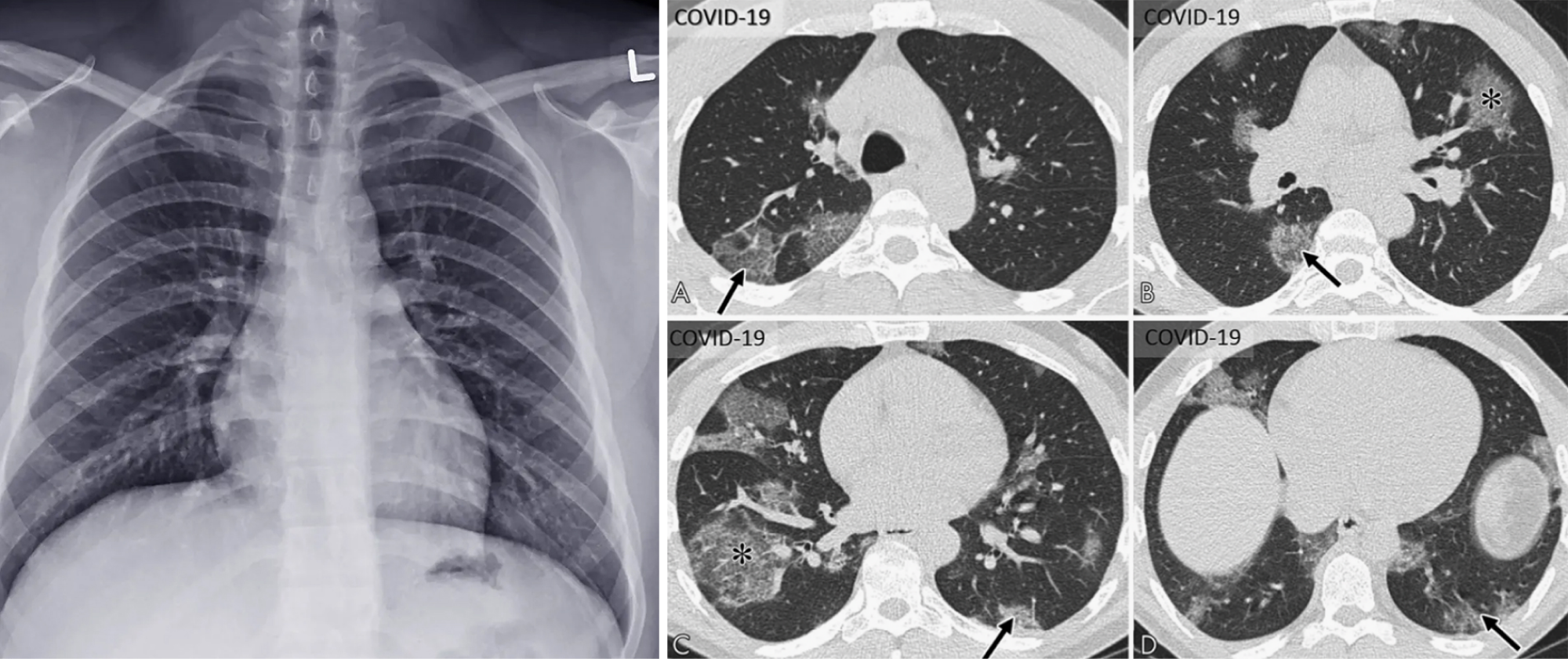 Слева — рентгенограмма грудной клетки, похожая на обычную фотографию. Справа — КТ⁠-⁠изображение грудной клетки, нарезанное на отдельные «ломтики», чтобы врачу было удобнее их изучать
