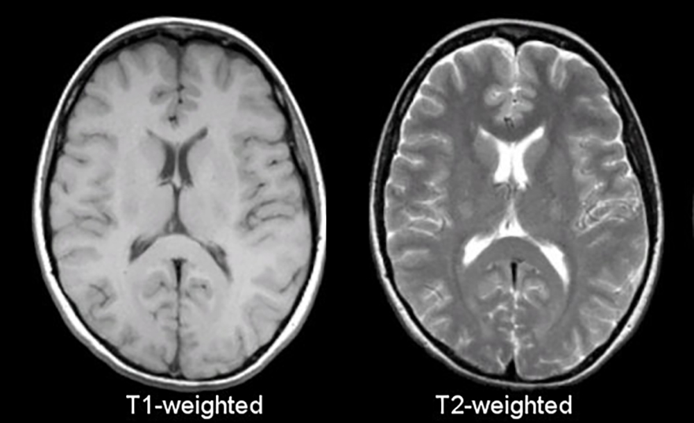 Так выглядят два МРТ-изображения одного и того же мозга, между извилинами которого находится спинномозговая жидкость. Цвет мозга и жидкости зависит от настроек аппарата, поэтому слева спинномозговая жидкость выглядит темной, справа — ярко-белой. Источник: case.edu