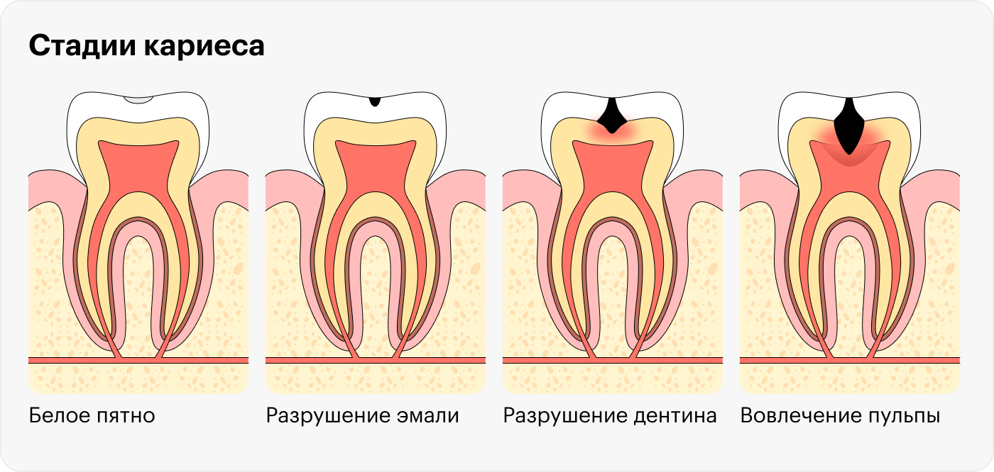 Разрушение зуба при кариесе начинается с крохотного белого пятнышка на эмали и заканчивается пульпитом