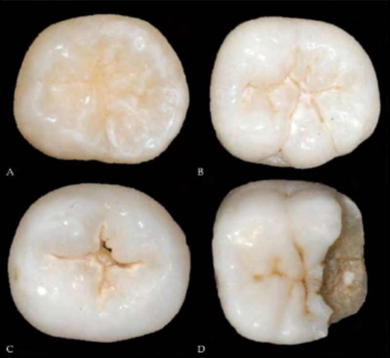 А — здоровый зуб. B—D — стадии развития кариеса от белого пятна до разрушения зуба. Источник: researchGate.net