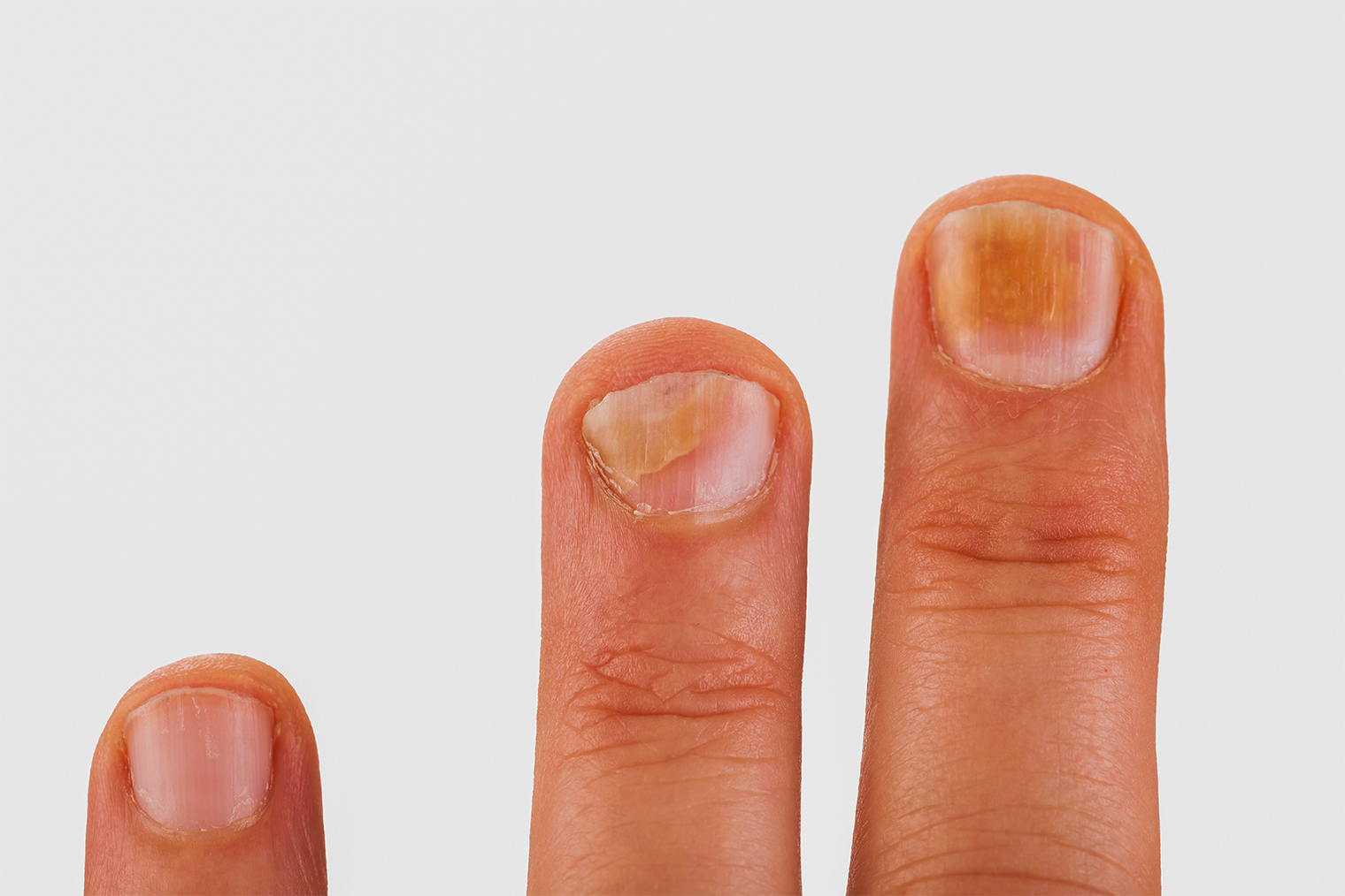 Ногти с грибковой инфекцией. Фото: Jan Schneckenhaus / Shutterstock