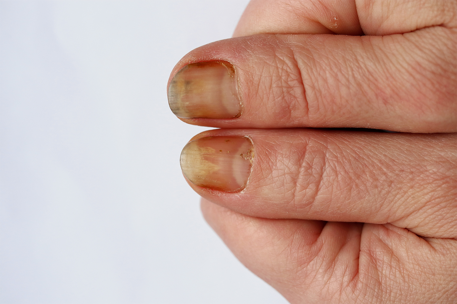 Ногти человека с псориазом. Фото: Millana / Shutterstock