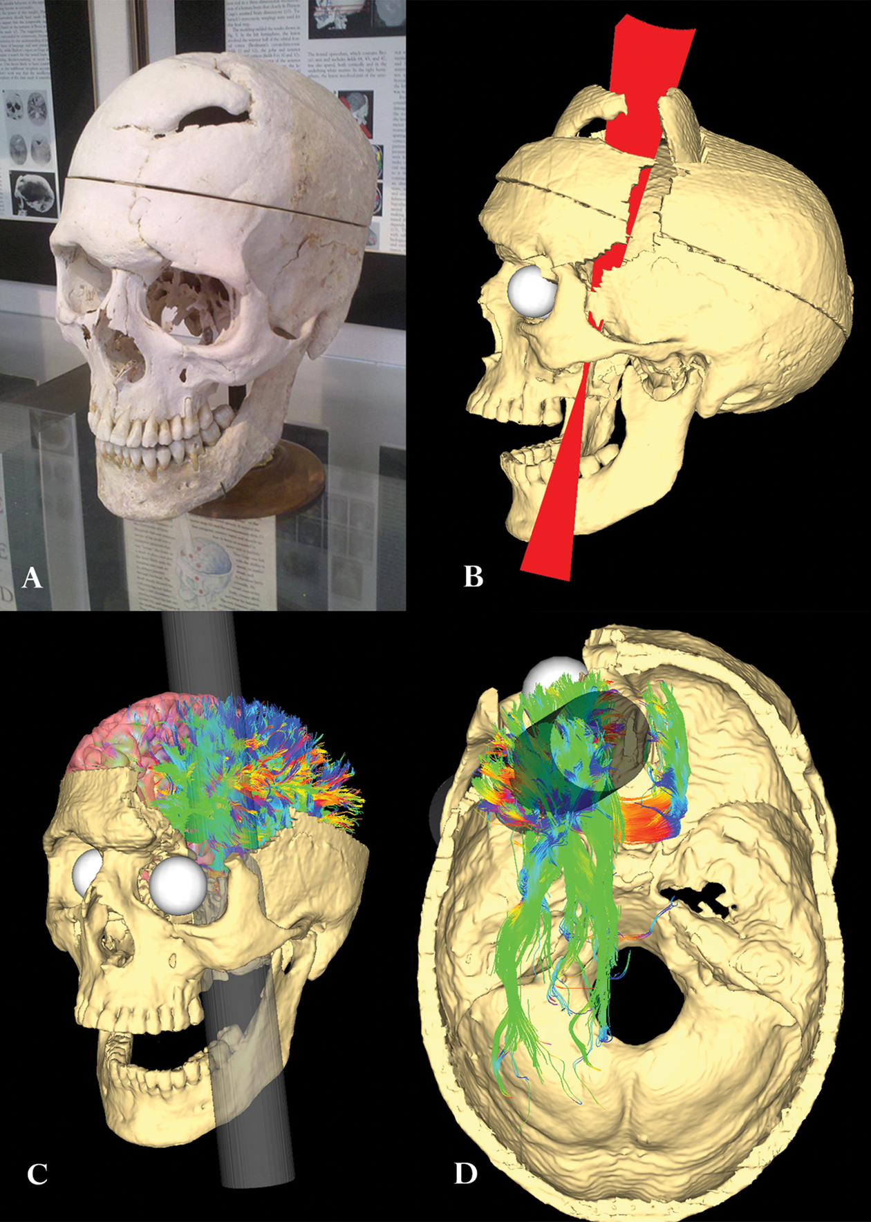 Модель травмы Финеаса Гейджа и ее влияние на структуру белого вещества мозга. Источник: journals.plos.org