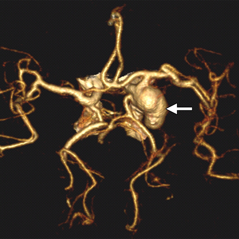 Аневризма сосудов головного мозга на трехмерном изображении при КТ⁠-⁠ангиографии. Выглядит устрашающе, но риск столкнуться с этим заболеванием очень низок. Источник: pubs.rsna.org