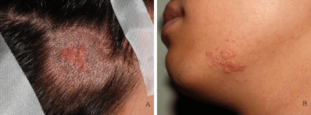 Невусы Ядассона на волосистой части головы и коже лица. Источник: researchgate.net