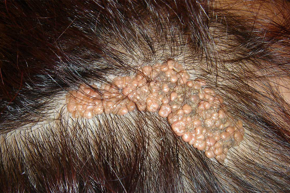 Гигантский невус Ядассона на голове. Источник: healthline.com