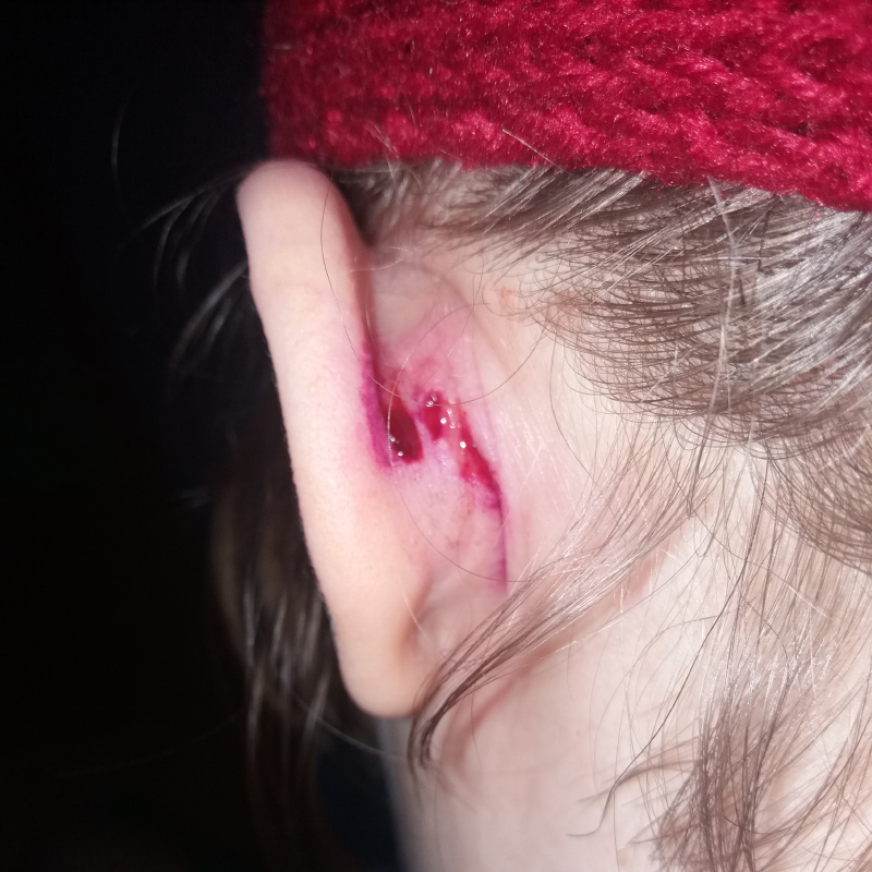 Спустя сутки после удаления, рана немного кровит