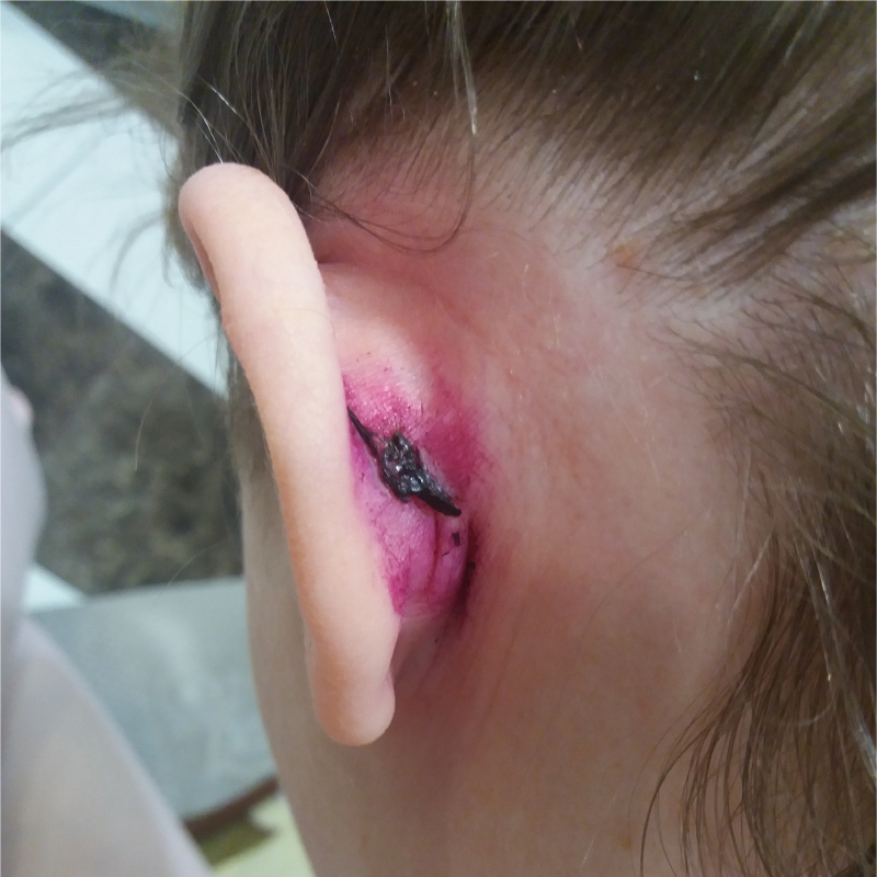 Спустя полторы недели после вмешательства на месте удаления образовалась корочка