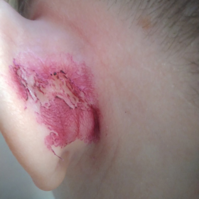 Спустя две с половиной недели после удаления рана почти зажила