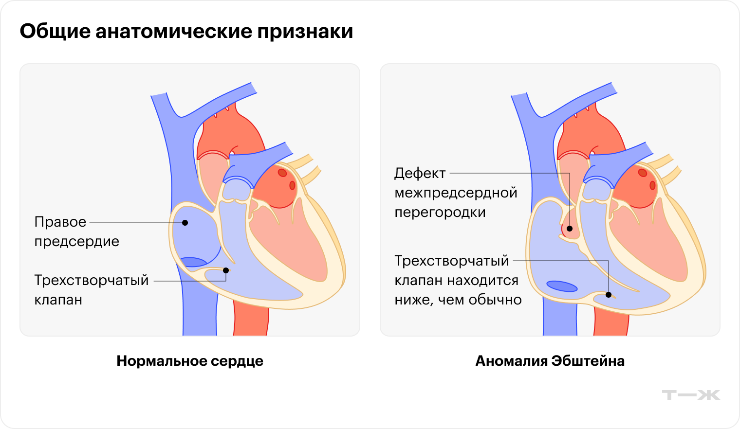 В норме трехстворчатый клапан расположен между двумя правыми камерами сердца. При аномалии Эбштейна он ниже, чем обычно, в правой нижней камере. Также меняется форма створок клапана. Это может привести к обратному притоку крови в правую верхнюю камеру сердца. Такое состояние называется регургитацией трехстворчатого клапана