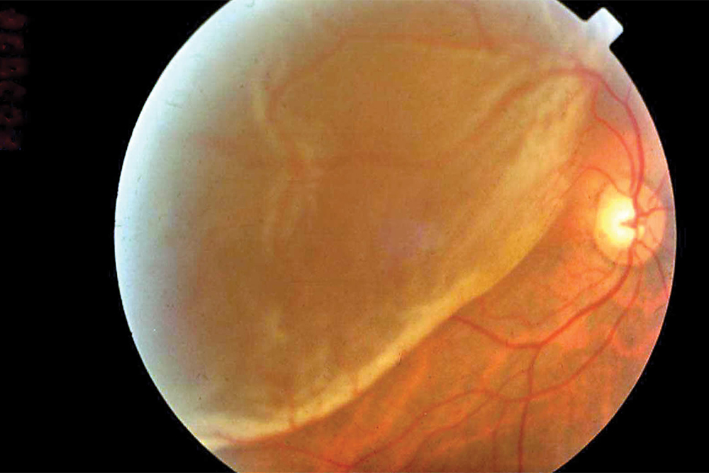 Отслойка сетчатки при осмотре глазного дна. Источник: cehjournal.org