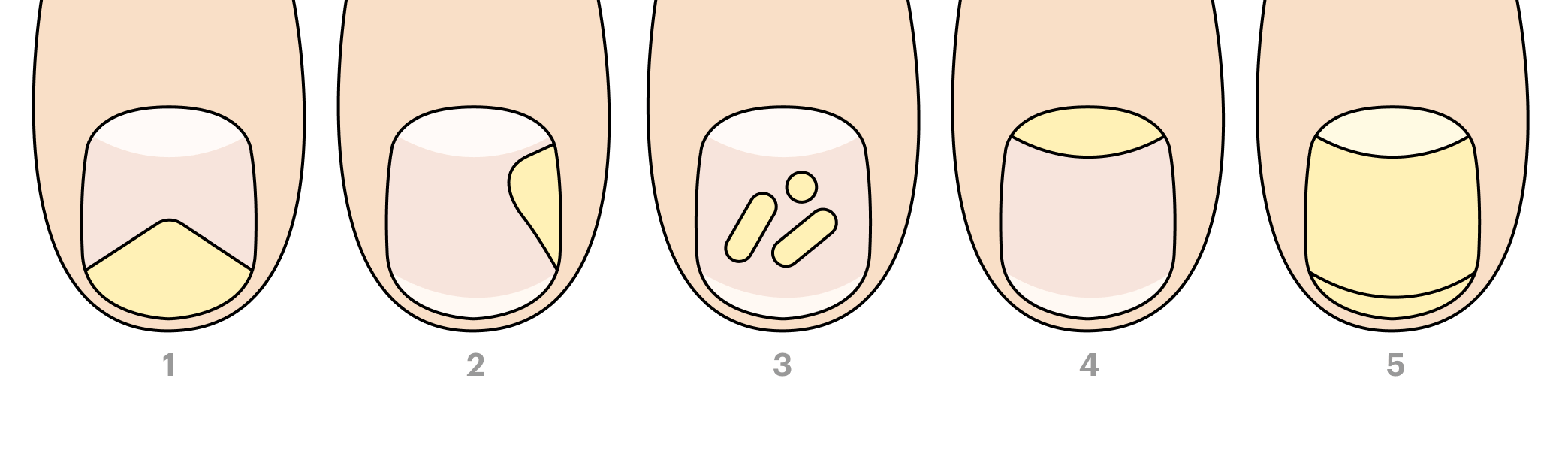 Разные виды грибка ногтей. 1 — дистальный онихомикоз, 2 — латеральный, 3 — белый поверхностный, 4 — проксимальный, 5 — общий дистрофический