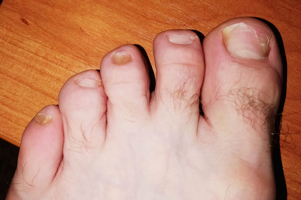 Это фото сделал 2 июня 2018 года — через месяц с небольшим после начала лечения. Прогресс уже заметен